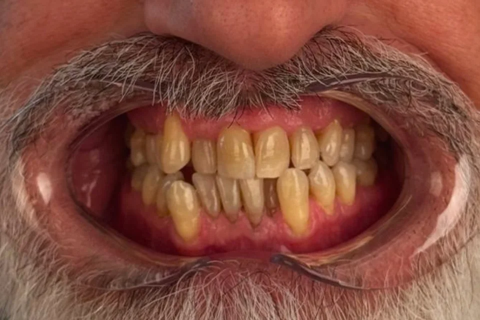 Case 1: Full-Mouth Zirconia Crowns — Before