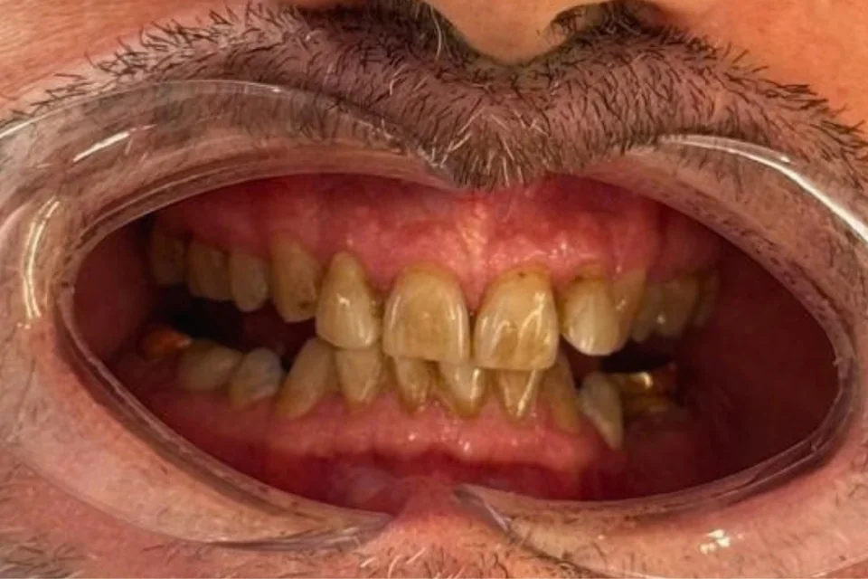 Case 2: Dental Implants and Zirconia Crowns — Before