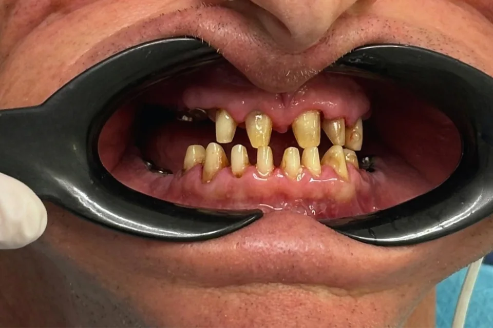 Case 3: Veneers — Before