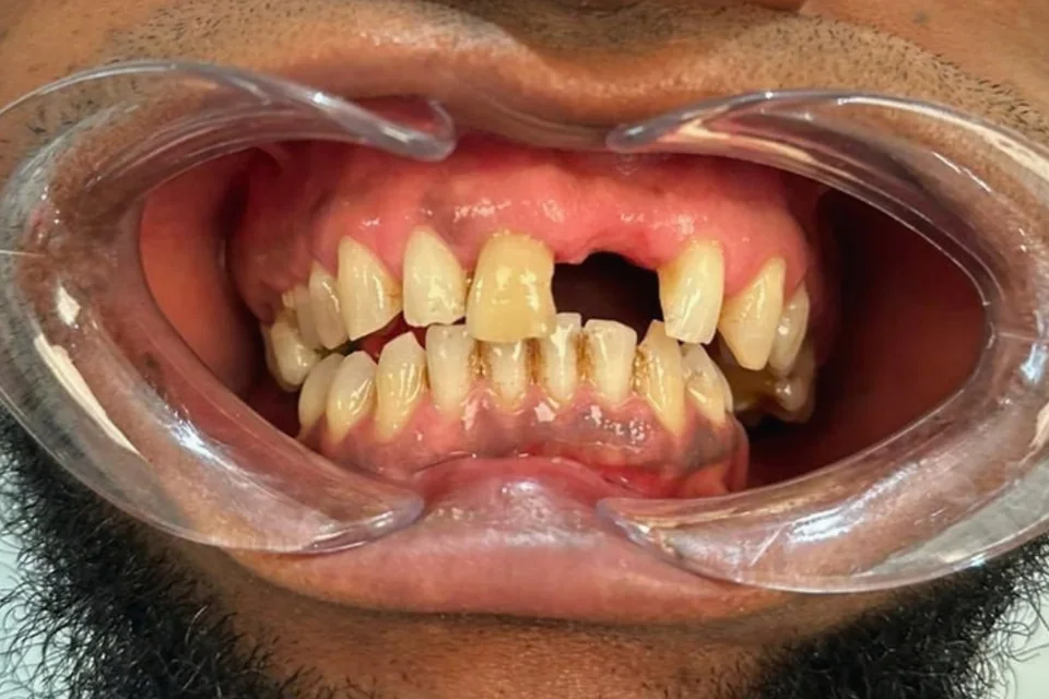 Case 5: Veneers — Before