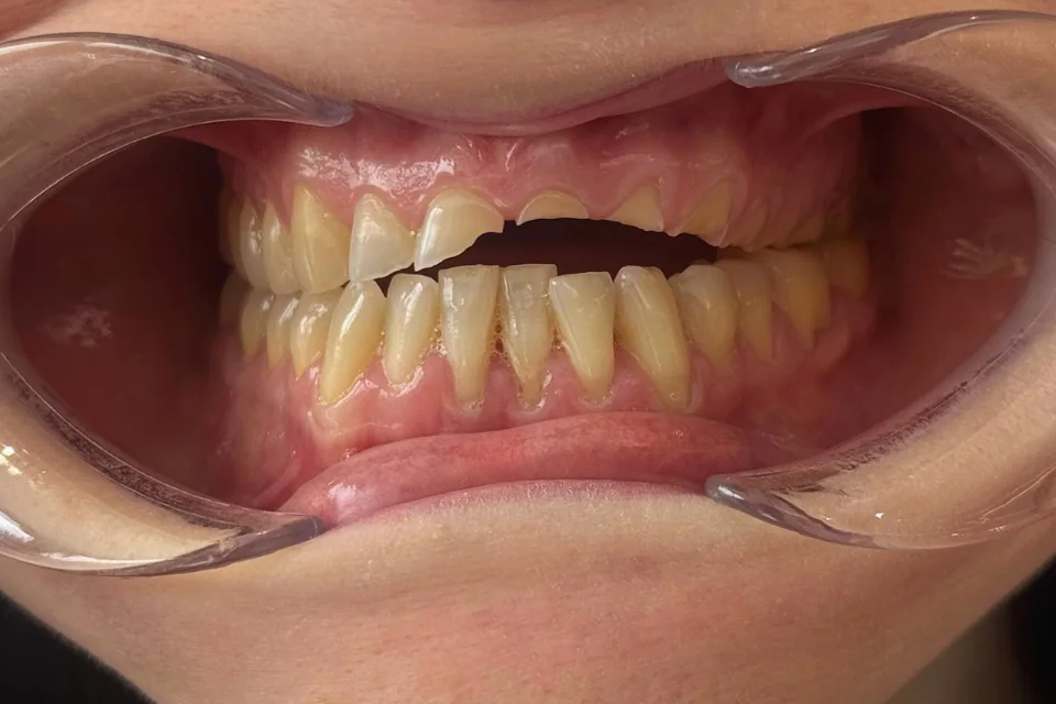Case 6: Veneers — Before