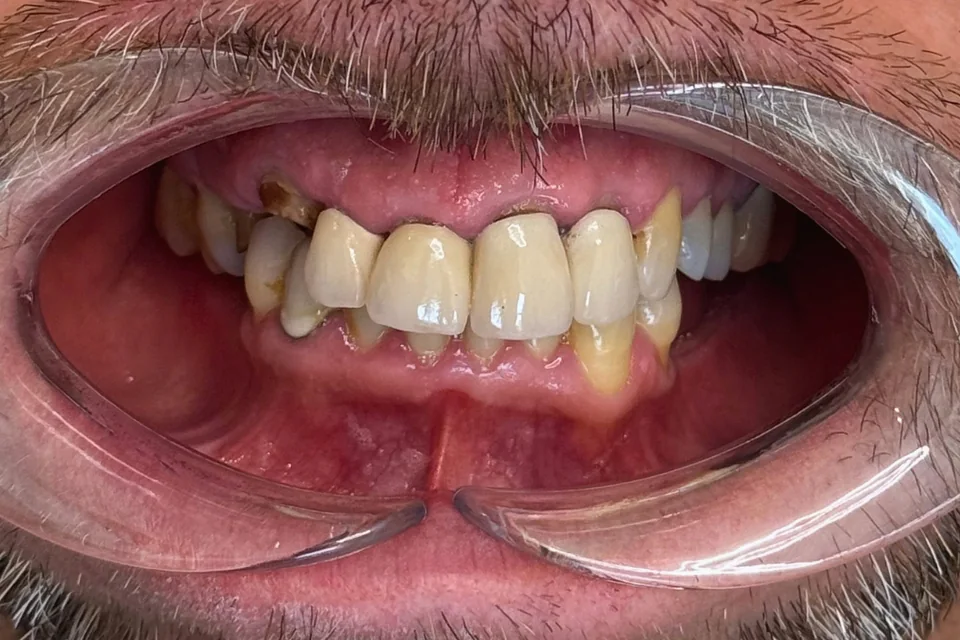 Case 7: Full-Mouth Dental Implants — Before