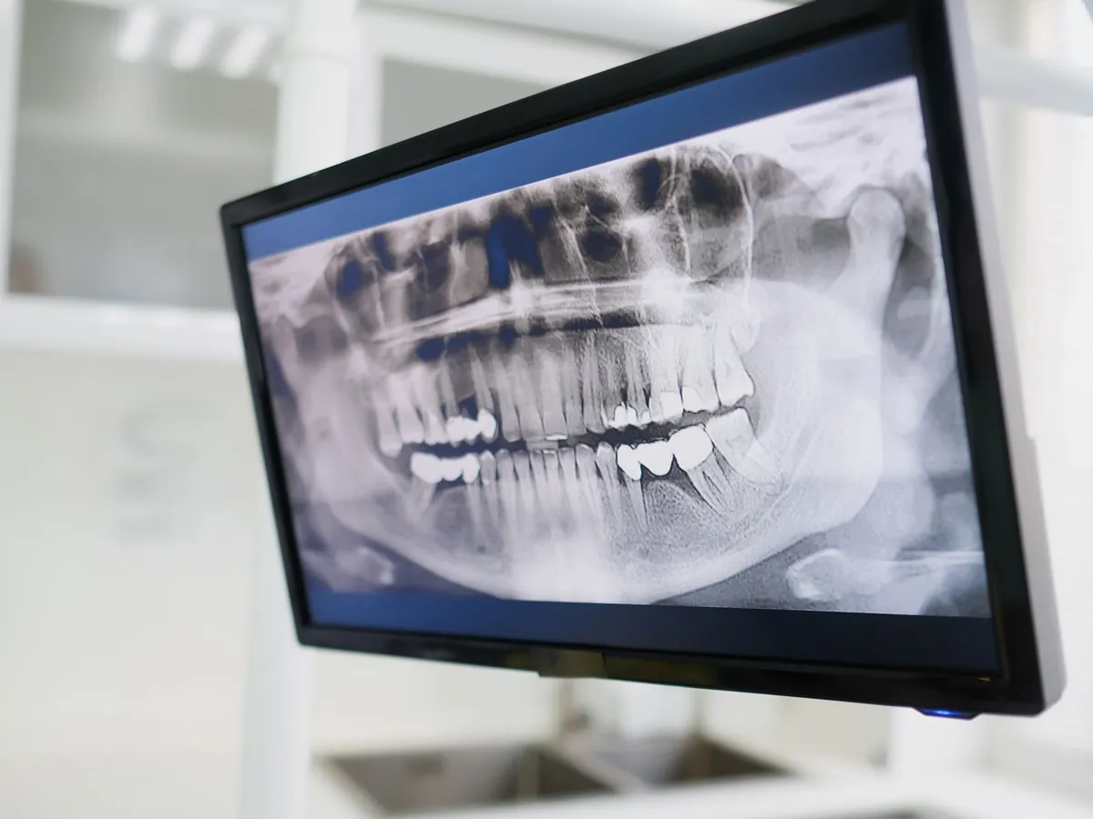 A panoramic dental X-ray on a monitor
