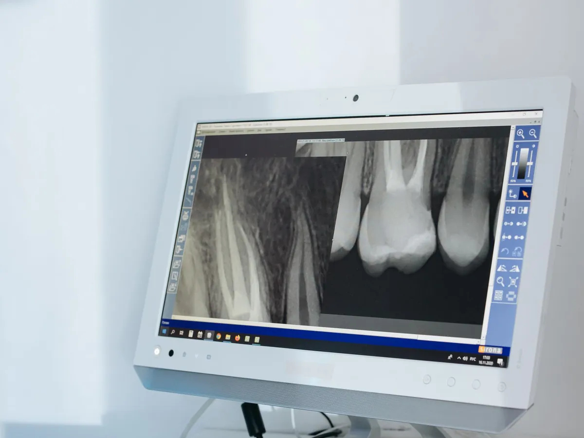Ein Röntgenbild von Zahnwurzeln auf einem Monitor in der Klinik