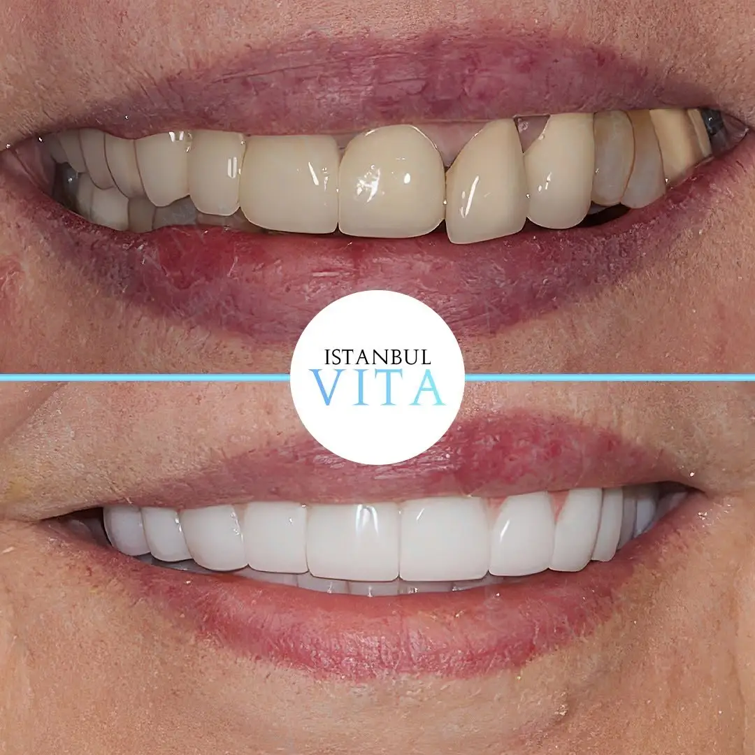 24 Zirconium Veneers Hollywood Smile Result after 6 months