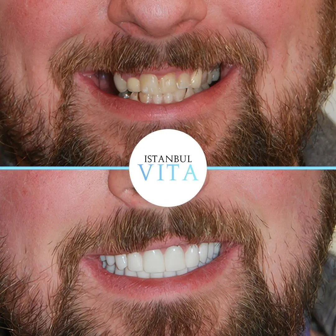 18 Zirconium Veneers and 1 Implant Result after 3 months