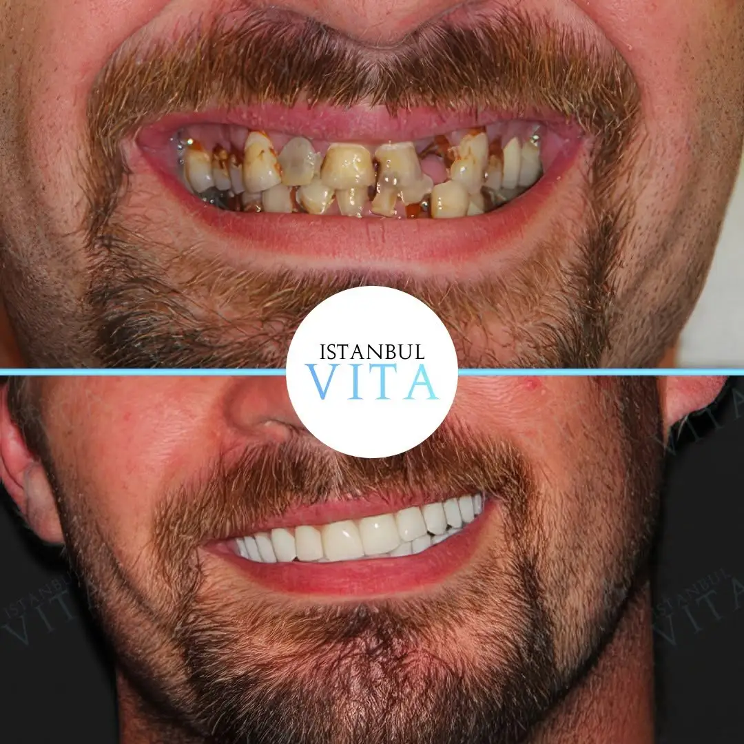 20 Zirconium Veneers Hollywood Smile Result after 4 months