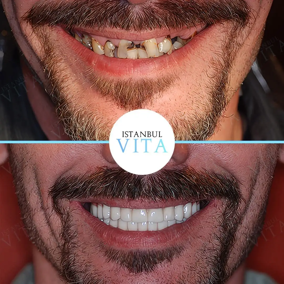 14 Zirconium Veneers Hollywood Smile Result after 6 months