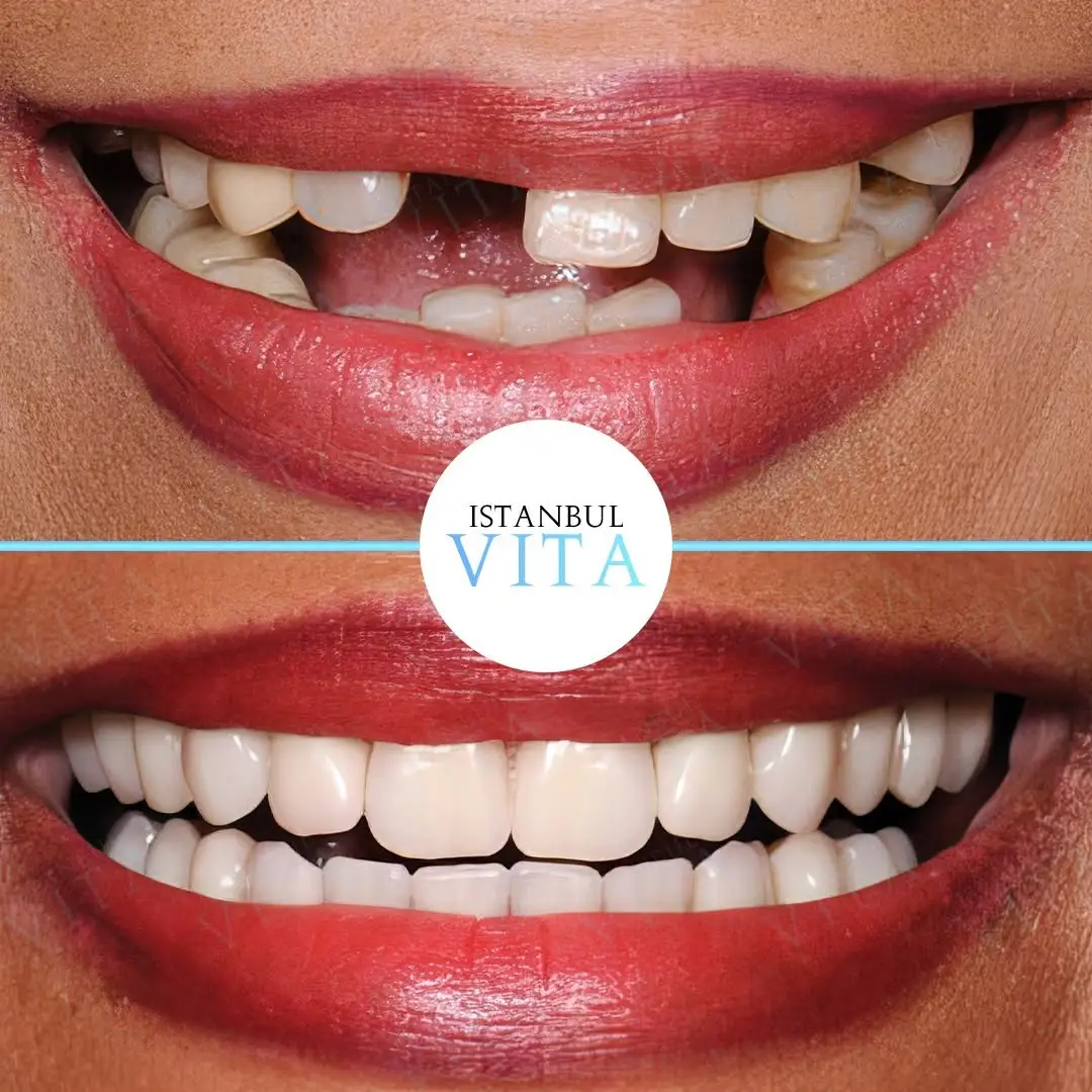 24 Zirconium Veneers and 2 Implants Result after 7 months