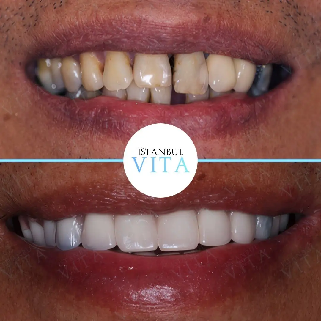 20 Zirconium Veneers Complete Smile Makeover after 5 months