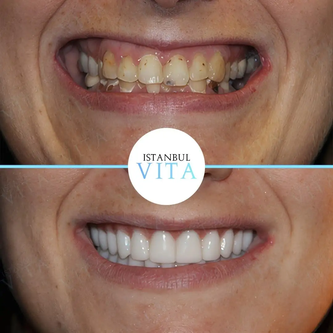 22 Zirconium Veneers Hollywood Smile Result after 8 months