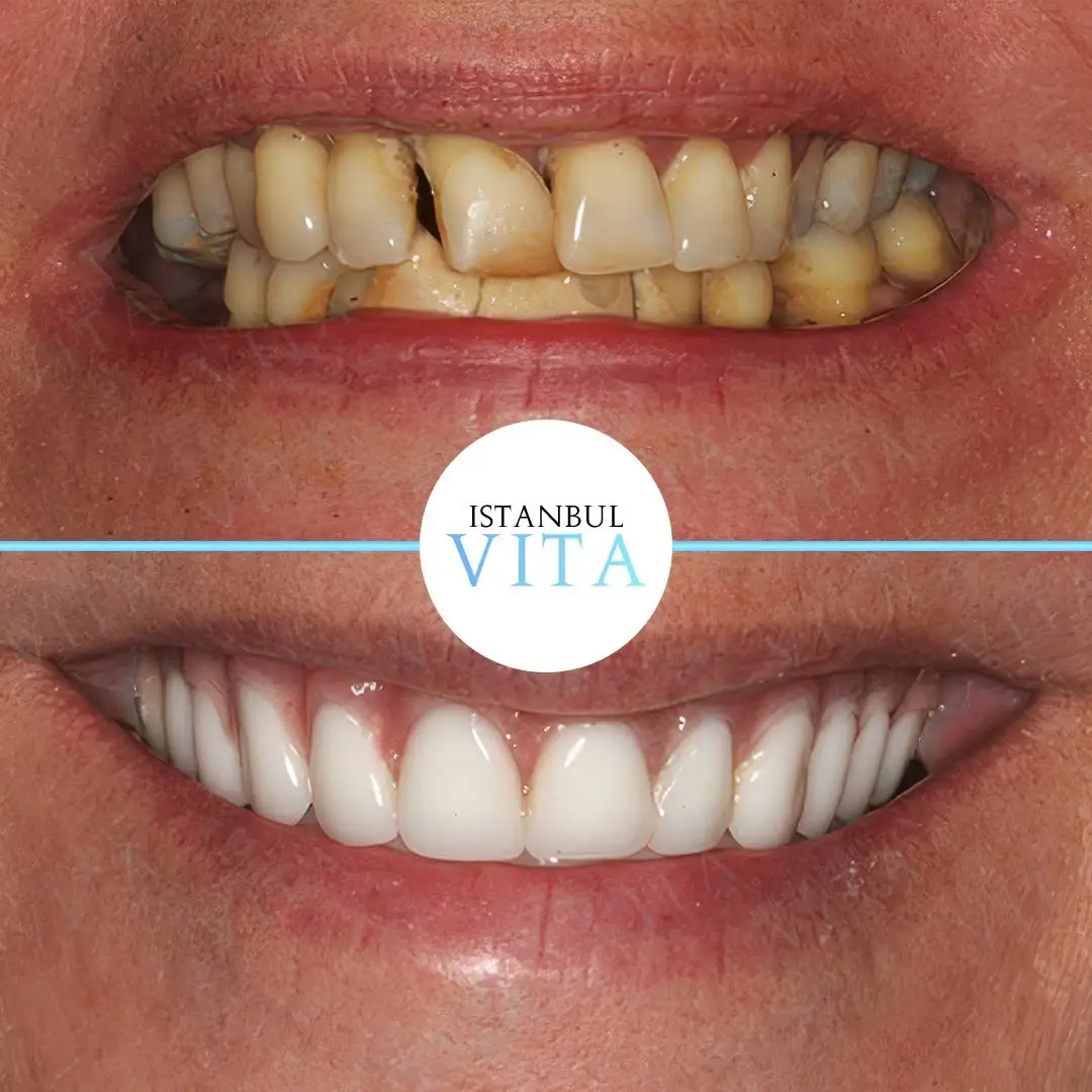 16 Zirconium Veneers Smile Design Result after 5 months